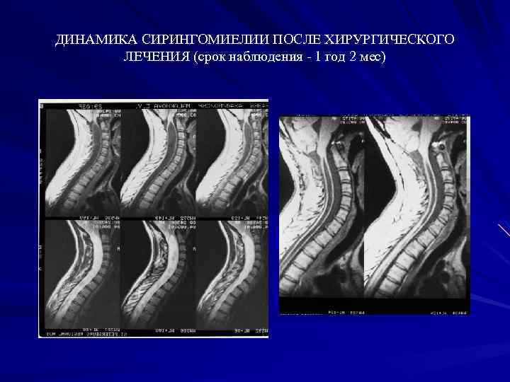 ДИНАМИКА СИРИНГОМИЕЛИИ ПОСЛЕ ХИРУРГИЧЕСКОГО ЛЕЧЕНИЯ (срок наблюдения - 1 год 2 мес) 