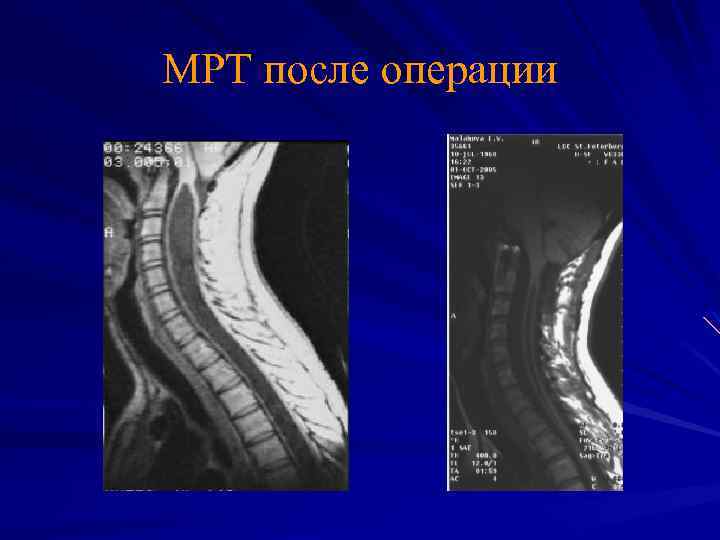 МРТ после операции 