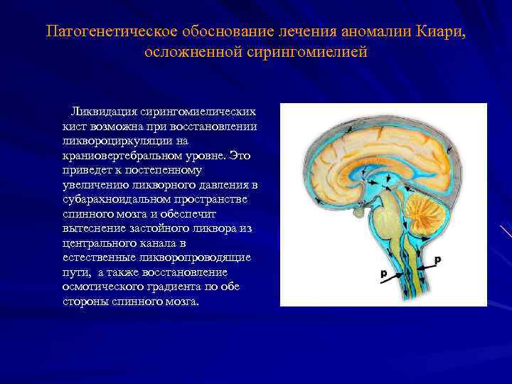 Патогенетическое обоснование лечения аномалии Киари, осложненной сирингомиелией Ликвидация сирингомиелических кист возможна при восстановлении ликвороциркуляции