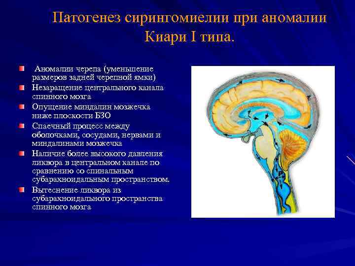 Патогенез сирингомиелии при аномалии Киари I типа. Аномалии черепа (уменьшение размеров задней черепной ямки)