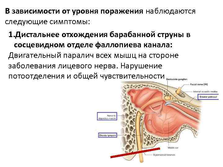 В зависимости от уровня поражения наблюдаются следующие симптомы: 1. Дистальнее отхождения барабанной струны в