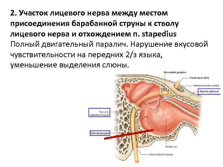 2. Участок лицевого нерва между местом присоединения барабанной струны к стволу лицевого нерва и