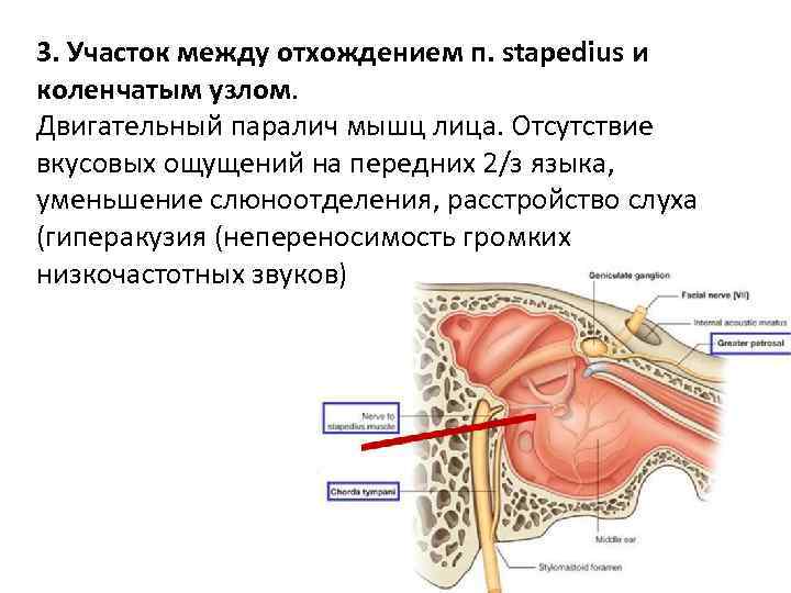 3. Участок между отхождением п. stapedius и коленчатым узлом. Двигательный паралич мышц лица. Отсутствие