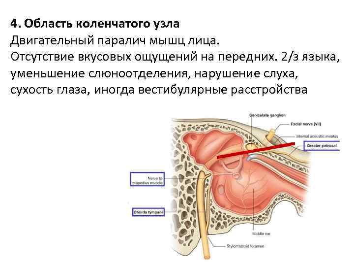 4. Область коленчатого узла Двигательный паралич мышц лица. Отсутствие вкусовых ощущений на передних. 2/з