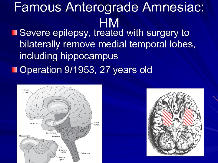 Famous Anterograde Amnesiac: HM Severe epilepsy, treated with surgery to bilaterally remove medial temporal