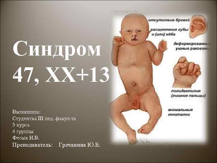 Синдром 47, XX+13 Выполнила: Студентка III пед. факул-та 5 курса 4 группы Фесык Н.
