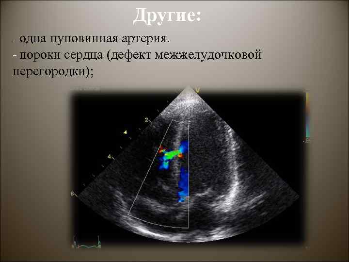 Другие: одна пуповинная артерия. - пороки сердца (дефект межжелудочковой перегородки); - 