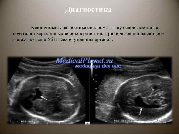 Диагностика Клиническая диагностика синдрома Патау основывается на сочетании характерных пороков развития. При подозрении на