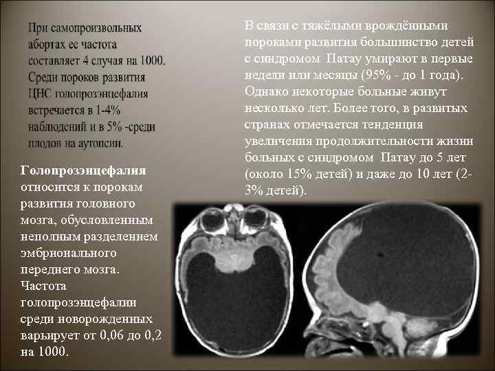 Голопрозэнцефалия относится к порокам развития головного мозга, обусловленным неполным разделением эмбрионального переднего мозга. Частота