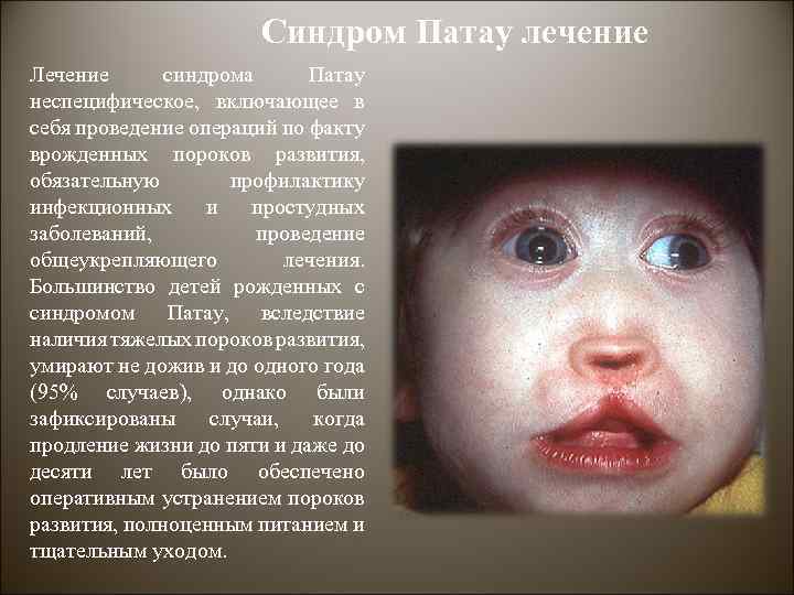 Синдром Патау лечение Лечение синдрома Патау неспецифическое, включающее в себя проведение операций по факту