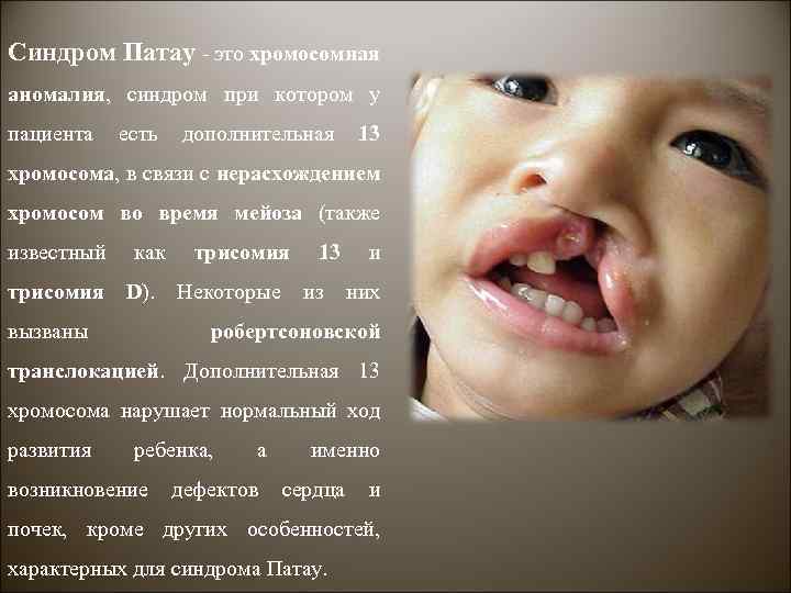 Синдром Патау - это хромосомная аномалия, синдром при котором у пациента есть дополнительная 13