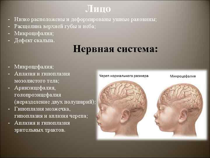 Лицо - Низко расположены и деформированы ушные раковины; Расщелина верхней губы и неба; Микроцефалия;