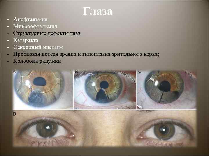 Глаза - Анофтальмия - Микроофтальмия - Структурные дефекты глаз - Катаракта - Сенсорный нистагм
