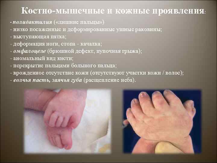 Костно-мышечные и кожные проявления: - полидактилия ( «лишние пальцы» ) - низко посаженные и