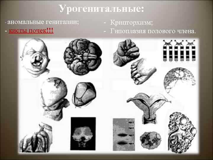 Урогенитальные: - аномальные гениталии; - кисты почек!!! - Крипторхизм; - Гипоплазия полового члена. 