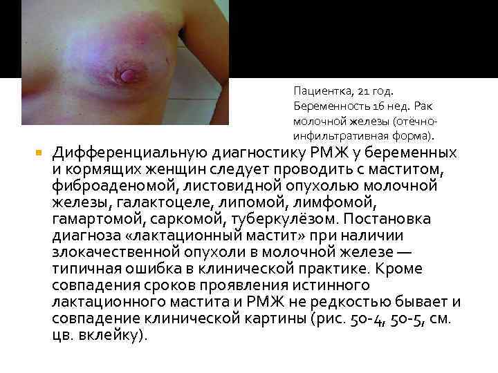 Пациентка, 21 год. Беременность 16 нед. Рак молочной железы (отёчноинфильтративная форма). Дифференциальную диагностику РМЖ