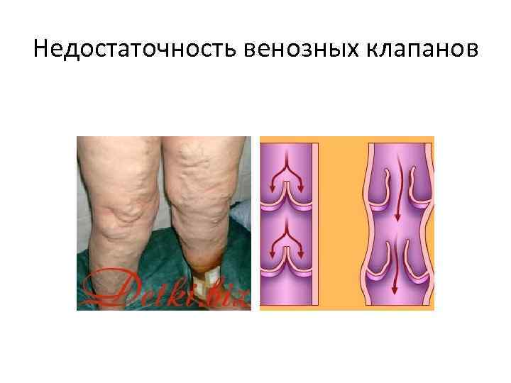 Недостаточность венозных клапанов 