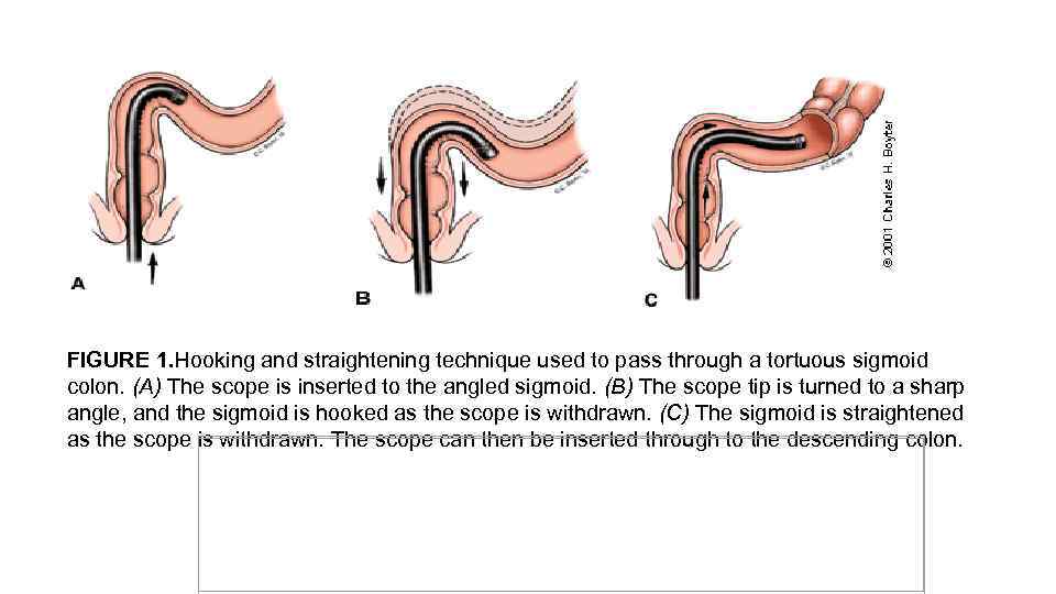 Techniques FIGURE 1. Hooking and straightening technique used to pass through a tortuous sigmoid