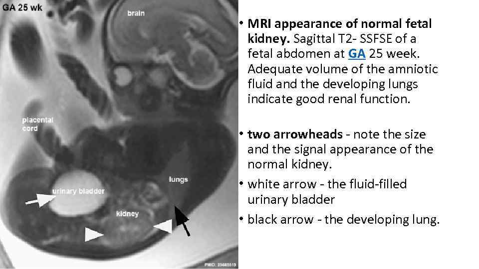  • MRI appearance of normal fetal kidney. Sagittal T 2 - SSFSE of