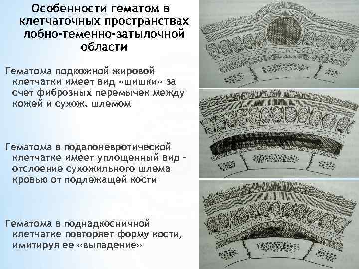 Особенности гематом в клетчаточных пространствах лобно-теменно-затылочной области Гематома подкожной жировой клетчатки имеет вид «шишки»