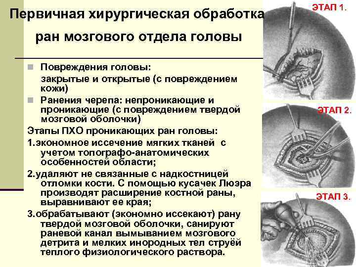 Первичная хирургическая обработка ЭТАП 1. ран мозгового отдела головы n Повреждения головы: закрытые и