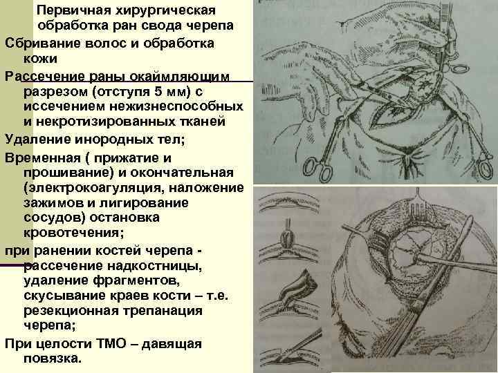 Первичная хирургическая обработка ран свода черепа Сбривание волос и обработка кожи Рассечение раны окаймляющим