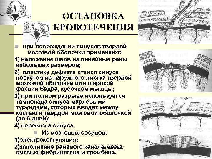 ОСТАНОВКА КРОВОТЕЧЕНИЯ n При повреждении синусов твердой мозговой оболочки применяют: 1) наложение швов на