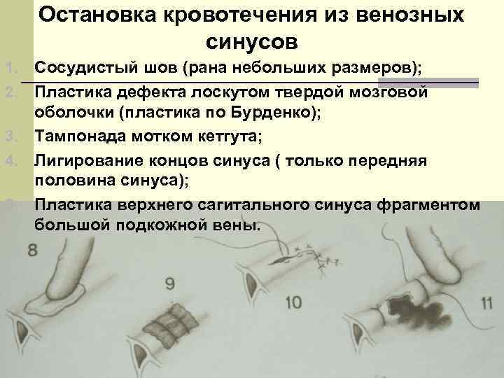 Остановка кровотечения из венозных синусов 1. 2. 3. 4. 5. Сосудистый шов (рана небольших