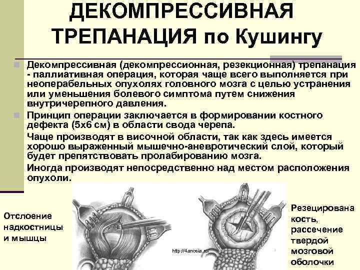 ДЕКОМПРЕССИВНАЯ ТРЕПАНАЦИЯ по Кушингу n Декомпрессивная (декомпрессионная, резекционная) трепанация - паллиативная операция, которая чаще