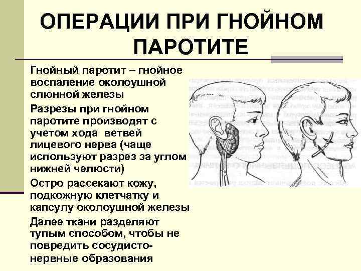 ОПЕРАЦИИ ПРИ ГНОЙНОМ ПАРОТИТЕ Гнойный паротит – гнойное воспаление околоушной слюнной железы Разрезы при
