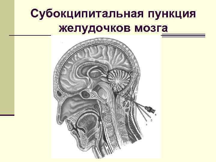 Субокципитальная пункция желудочков мозга 