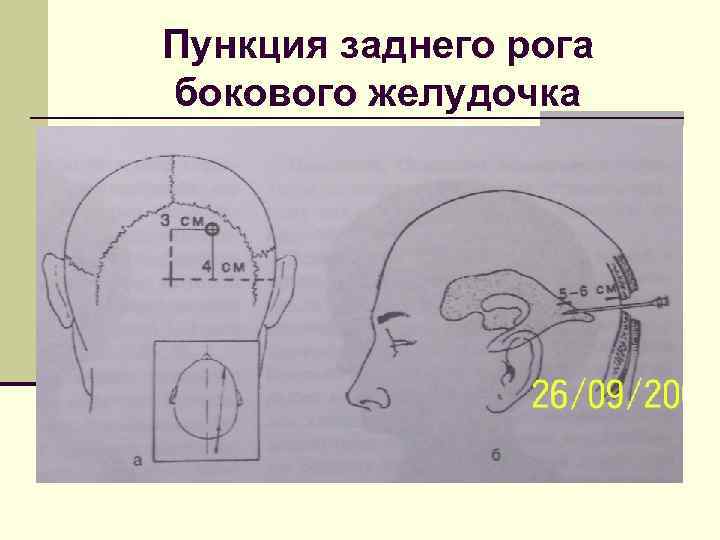 Пункция заднего рога бокового желудочка 