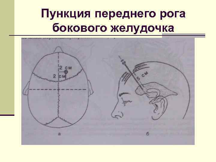 Пункция переднего рога бокового желудочка 