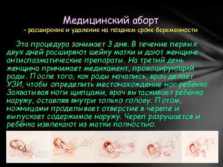 Медицинский аборт – расширение и удаление на позднем сроке беременности Эта процедура занимает 3