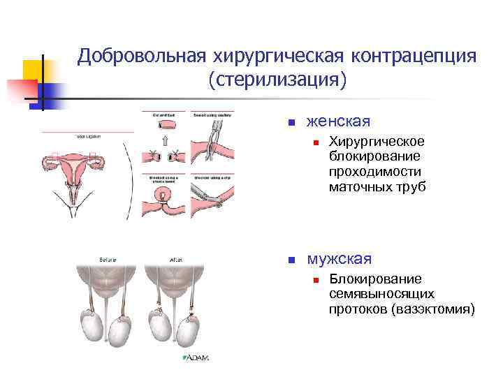 Добровольная хирургическая контрацепция (стерилизация) n женская n n Хирургическое блокирование проходимости маточных труб мужская