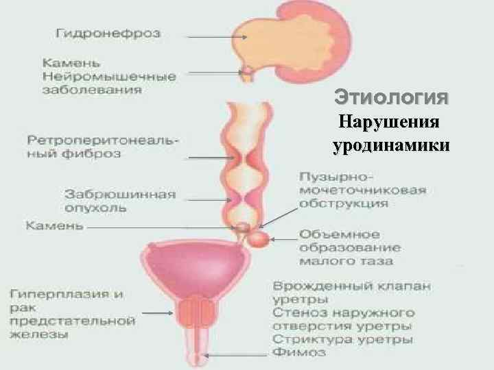 Этиология Нарушения уродинамики 