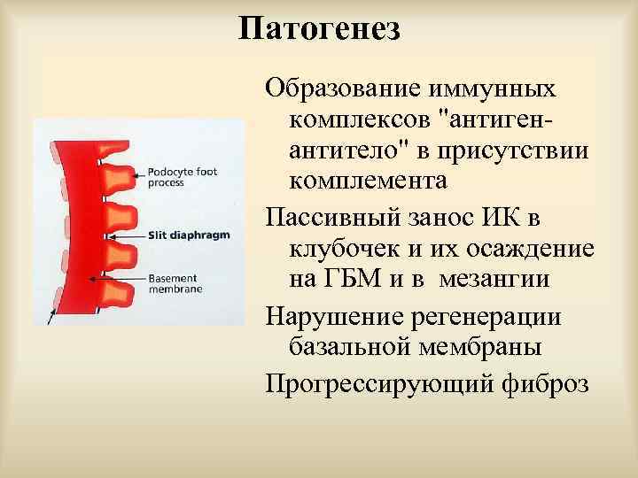 Патогенез Образование иммунных комплексов "антигенантитело" в присутствии комплемента Пассивный занос ИК в клубочек и