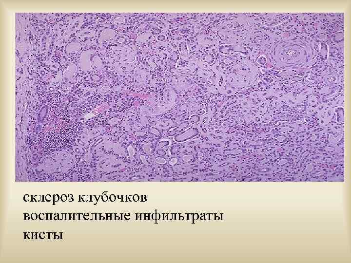 склероз клубочков воспалительные инфильтраты кисты 