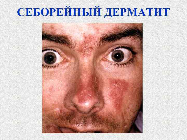 СЕБОРЕЙНЫЙ ДЕРМАТИТ 
