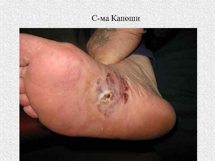 С-ма Капоши 