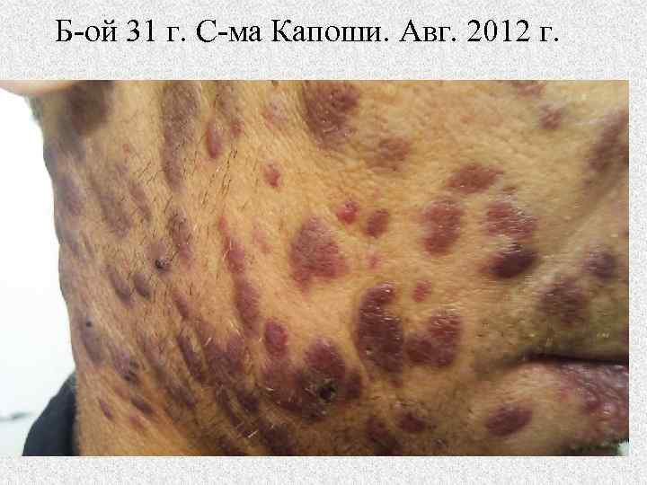 Б-ой 31 г. С-ма Капоши. Авг. 2012 г. 