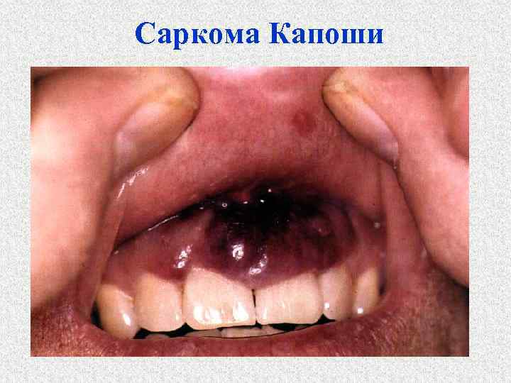 Саркома Капоши 