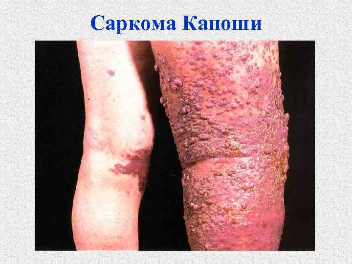 Саркома Капоши 
