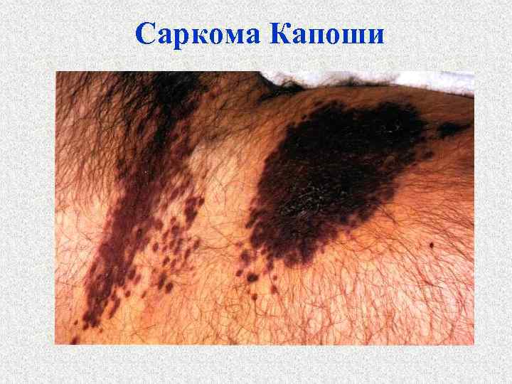 Саркома Капоши 