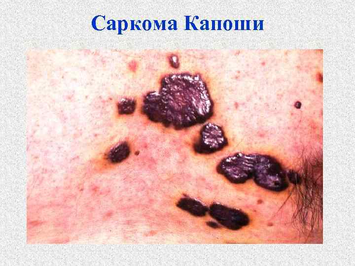 Саркома Капоши 