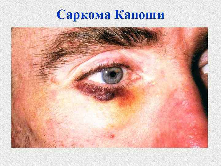 Саркома Капоши 