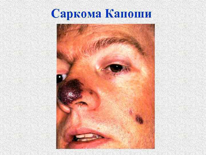 Саркома Капоши 