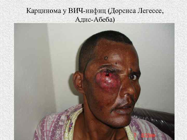 Карцинома у ВИЧ-инфиц (Дорсиса Легессе, Адис-Абеба) 
