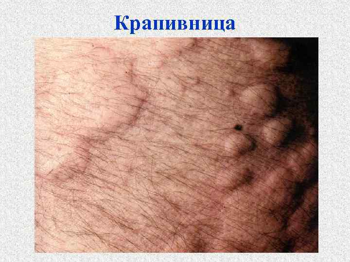 Крапивница 