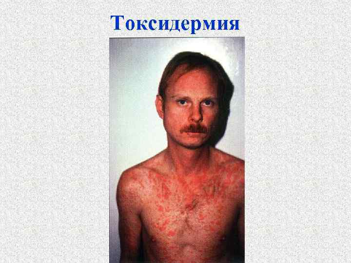 Токсидермия 